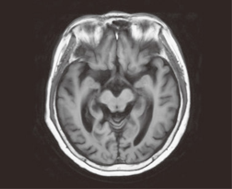 アルツハイマー病MRI