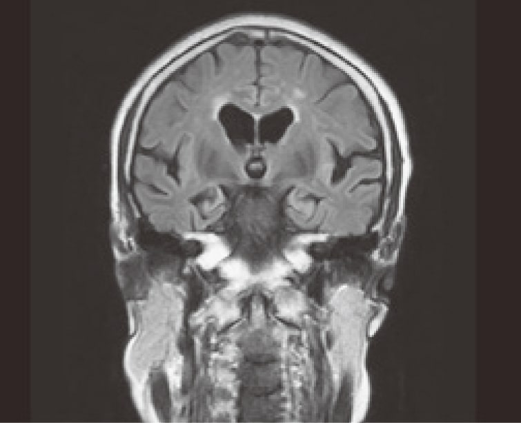 アルツハイマー病MRI
