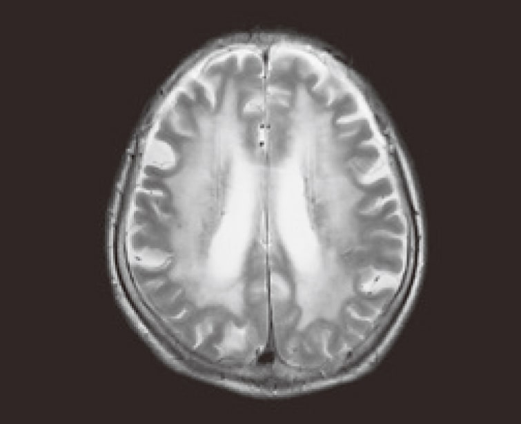 脳血管性認知症MRI