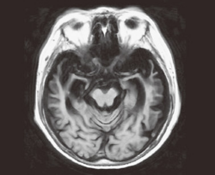 前頭側頭葉変性症MRI