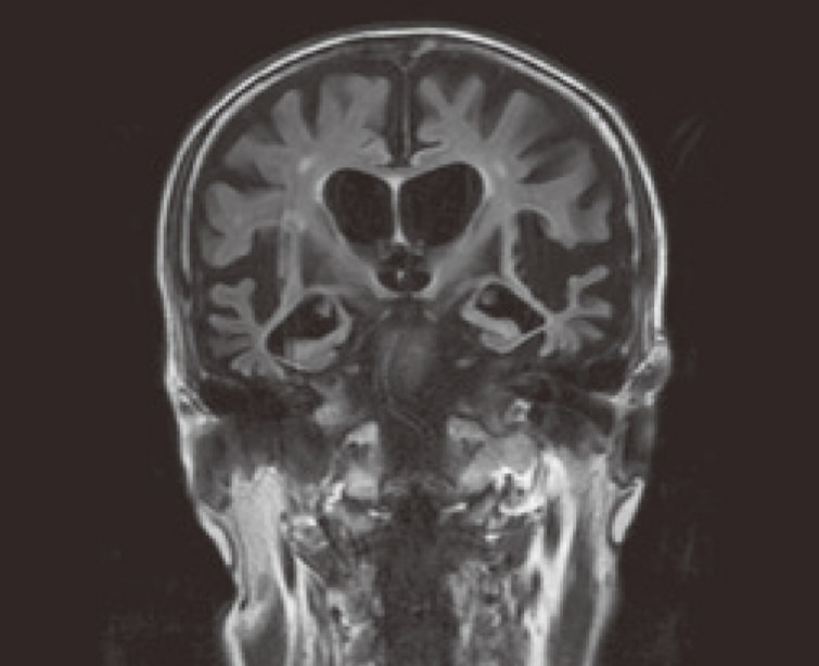 前頭側頭葉変性症MRI