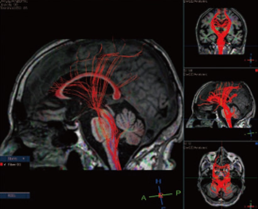 特発性正常圧水頭症MRI