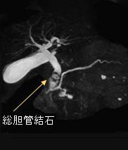 総胆管結石