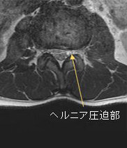 ヘルニア圧迫部