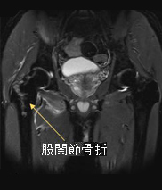 股関節骨折