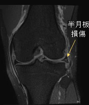 半月板損傷