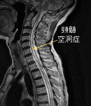 頸椎空洞症